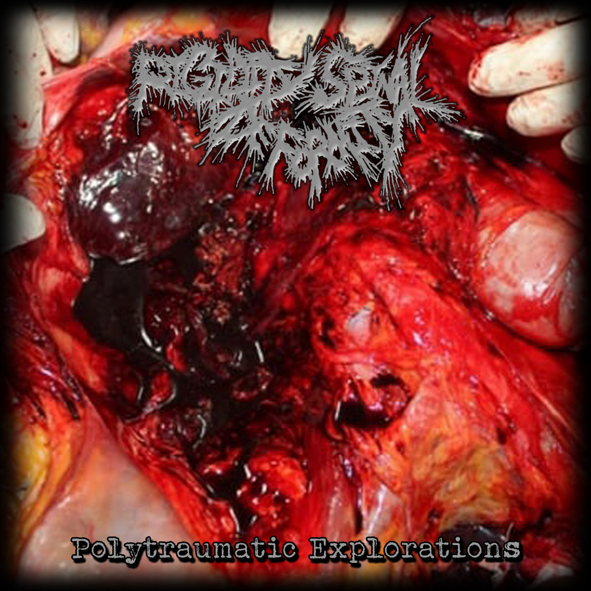 Rigidity Spinal Deformity - Polytraumatic Explorations